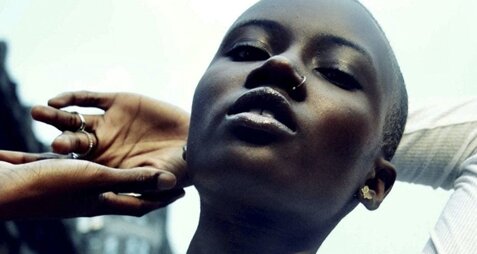 Chemical Peels